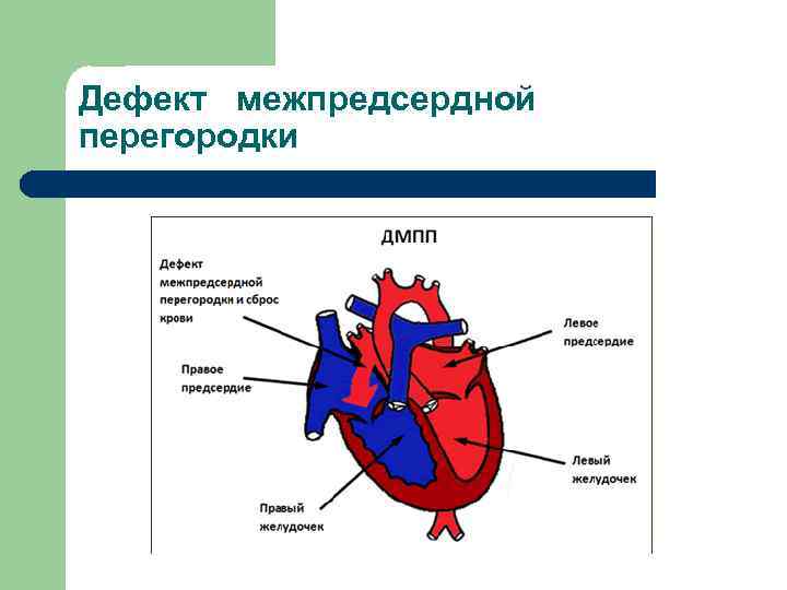 Дефект межпредсердной перегородки 