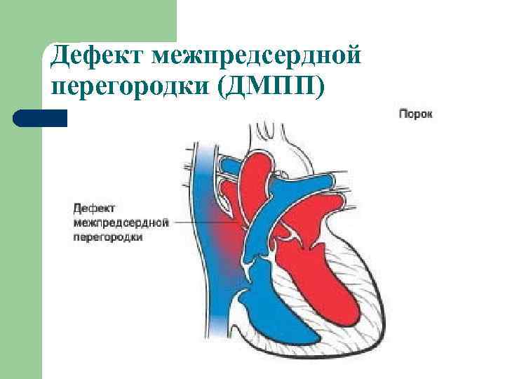 Дефект межпредсердной перегородки (ДМПП) 