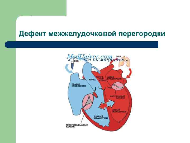 Дефект межжелудочковой перегородки 