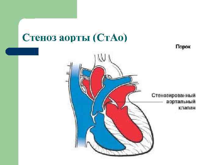 Стеноз аорты (Ст. Ао) 