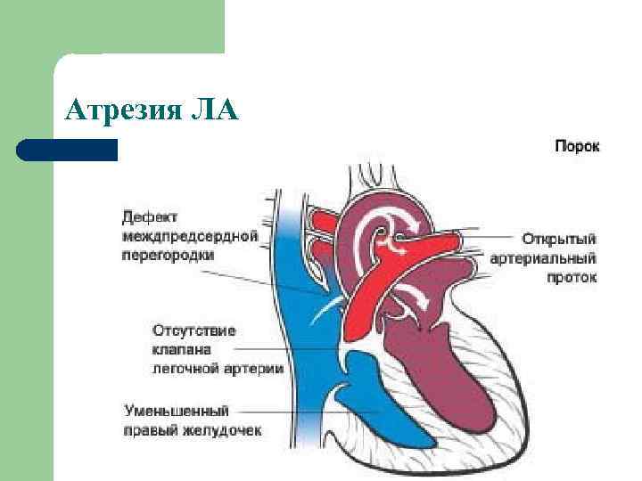 Атрезия ЛА 