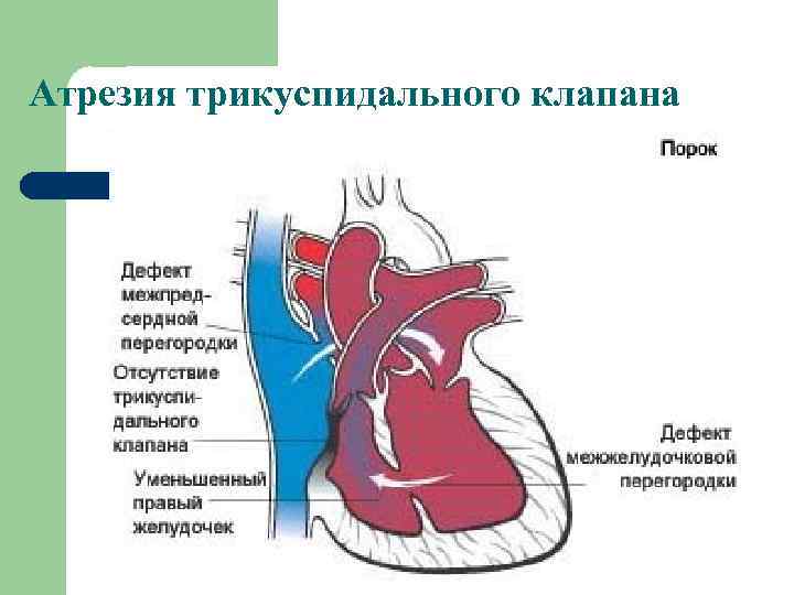 Атрезия трехстворчатого клапана презентация