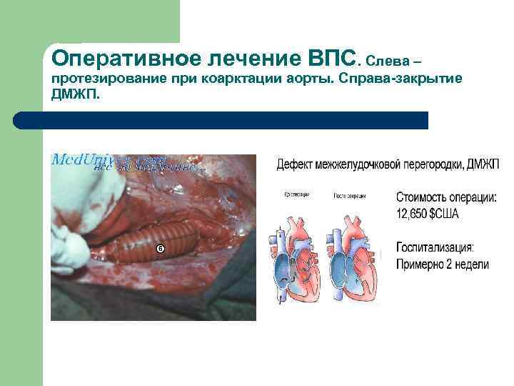 Оперативное лечение ВПС. Слева – протезирование при коарктации аорты. Справа-закрытие ДМЖП. 