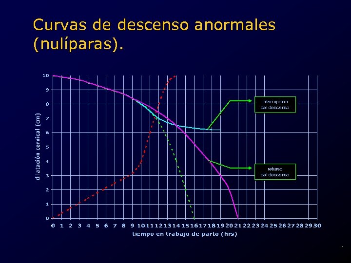 Curvas de descenso anormales (nulíparas). interrupción del descenso retraso del descenso . 