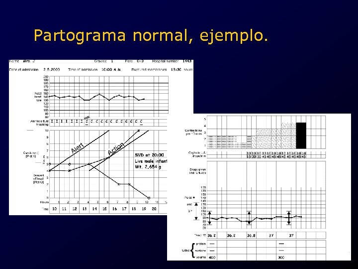 Partograma normal, ejemplo. . 