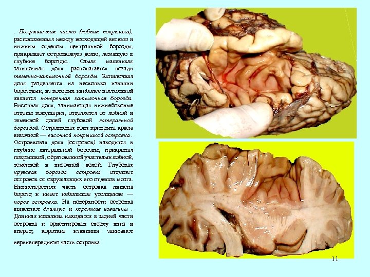 . Покрышечная часть (лобная покрышка), расположенная между восходящей ветвью и нижним отделом центральной борозды,