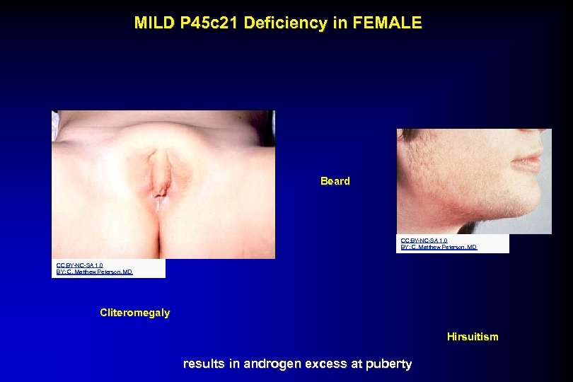 MILD P 45 c 21 Deficiency in FEMALE Beard CC: BY-NC-SA 1. 0 BY: