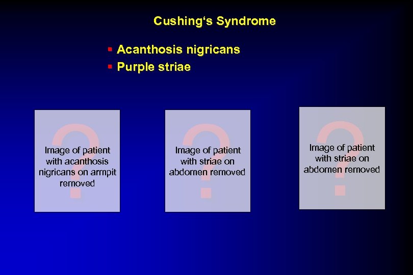 Cushing‘s Syndrome § Acanthosis nigricans § Purple striae ? ? ? Image of patient