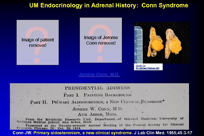 UM Endocrinology in Adrenal History: Conn Syndrome ? ? Image of patient removed Image