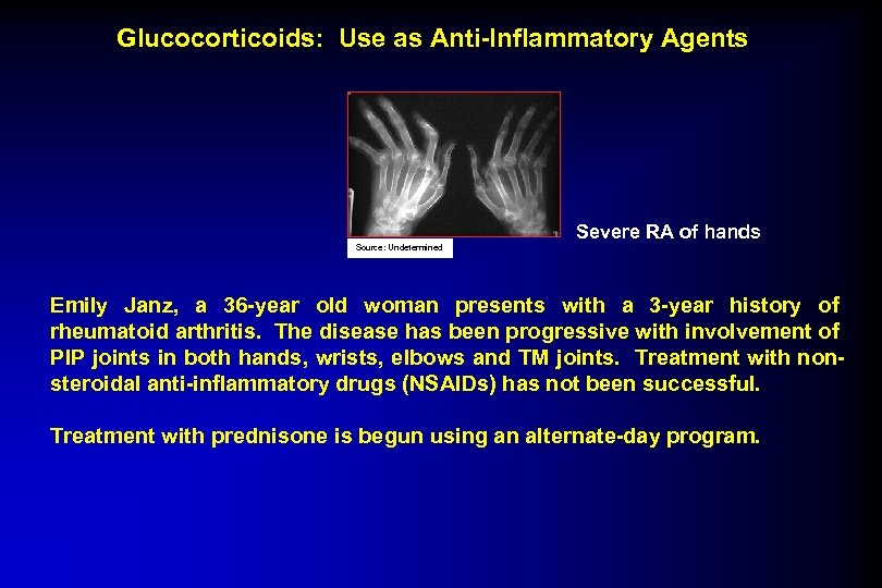 Glucocorticoids: Use as Anti-Inflammatory Agents Severe RA of hands Source: Undetermined Emily Janz, a