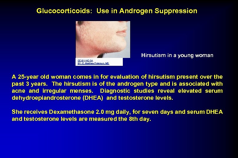 Glucocorticoids: Use in Androgen Suppression Hirsutism in a young woman CC: BY-NC-SA BY: C.