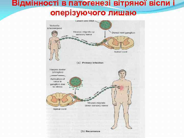 Відмінності в патогенезі вітряної віспи і оперізуючого лишаю 