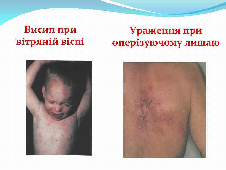 Висип при вітряній віспі Ураження при оперізуючому лишаю 