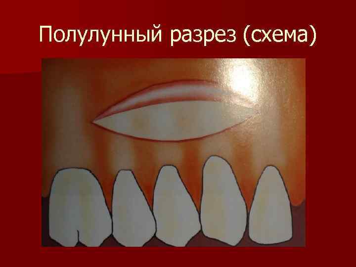 Полулунный разрез (схема) 