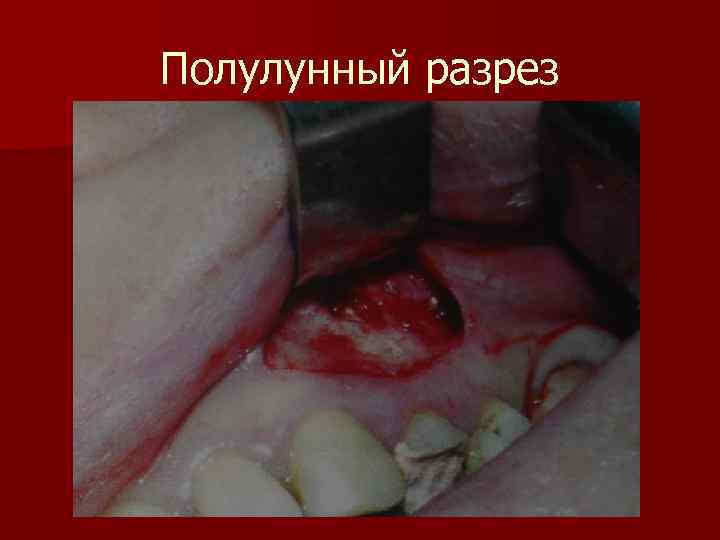 Полулунный разрез 