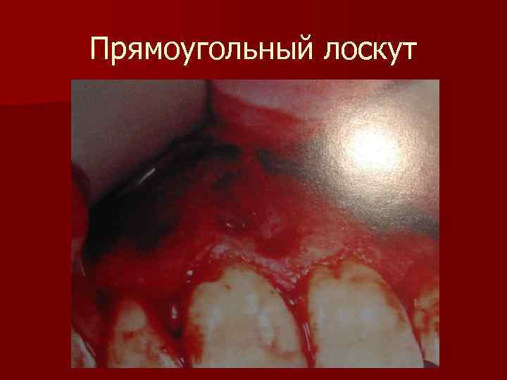 Прямоугольный лоскут 