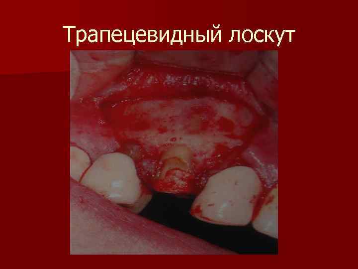 Трапецевидный лоскут 