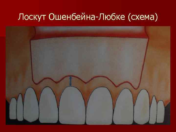 Лоскут Ошенбейна-Любке (схема) 