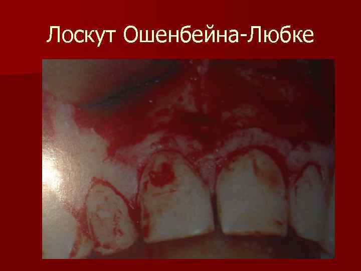 Лоскут Ошенбейна-Любке 