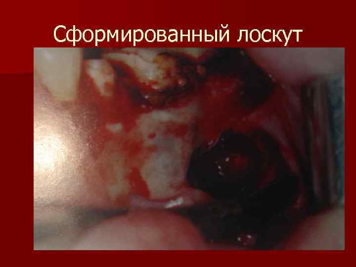 Сформированный лоскут 