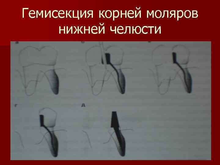 Гемисекция корней моляров нижней челюсти 