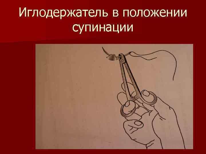 Иглодержатель в положении супинации 
