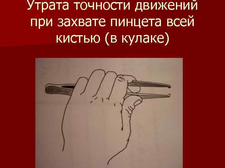 Утрата точности движений при захвате пинцета всей кистью (в кулаке) 