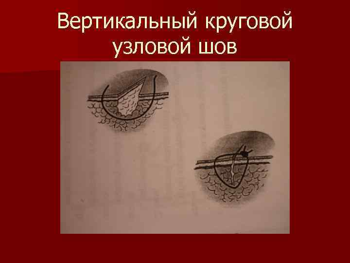 Вертикальный круговой узловой шов 