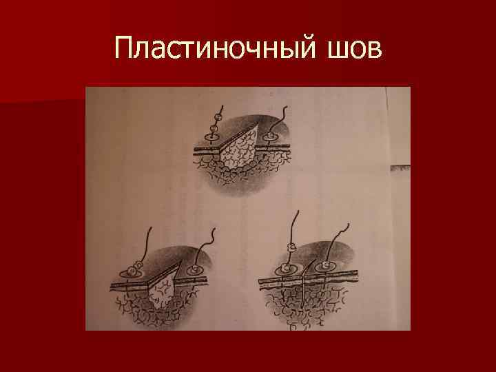 Пластиночный шов 