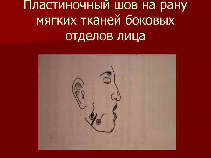 Пластиночный шов на рану мягких тканей боковых отделов лица 