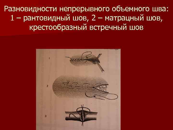 Разновидности непрерывного объемного шва: 1 – рантовидный шов, 2 – матрацный шов, крестообразный встречный