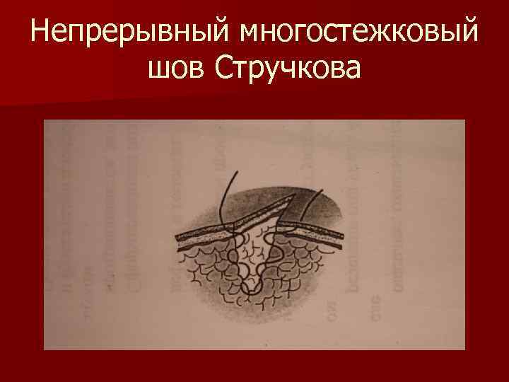 Непрерывный многостежковый шов Стручкова 