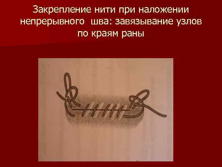 Закрепление нити при наложении непрерывного шва: завязывание узлов по краям раны 