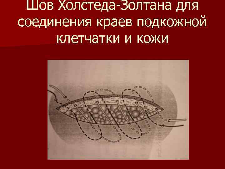 Шов Холстеда-Золтана для соединения краев подкожной клетчатки и кожи 