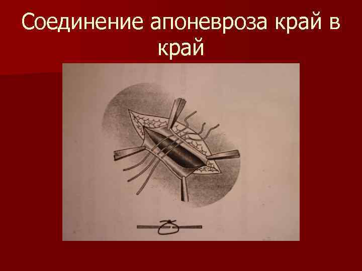 Соединение апоневроза край в край 