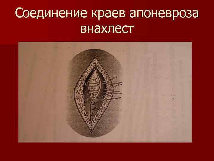 Соединение краев апоневроза внахлест 