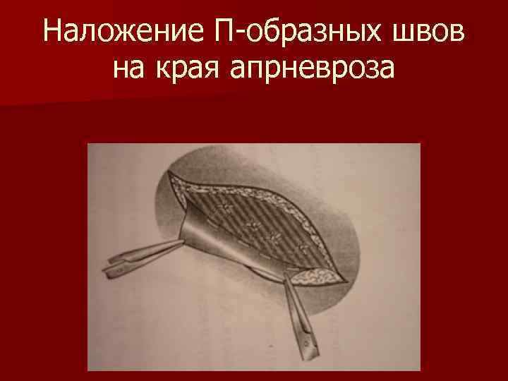 Наложение П-образных швов на края апрневроза 
