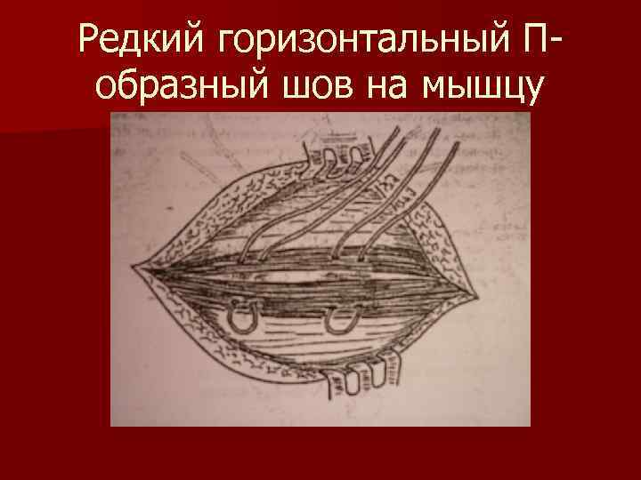 Редкий горизонтальный Побразный шов на мышцу 