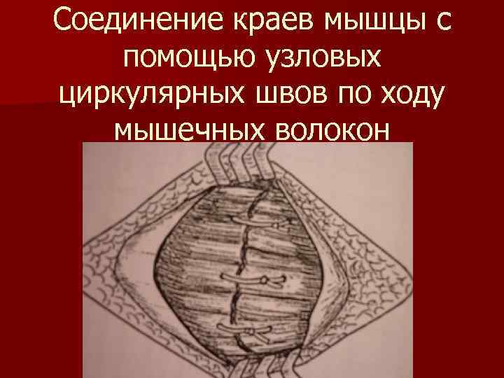 Соединение краев мышцы с помощью узловых циркулярных швов по ходу мышечных волокон 