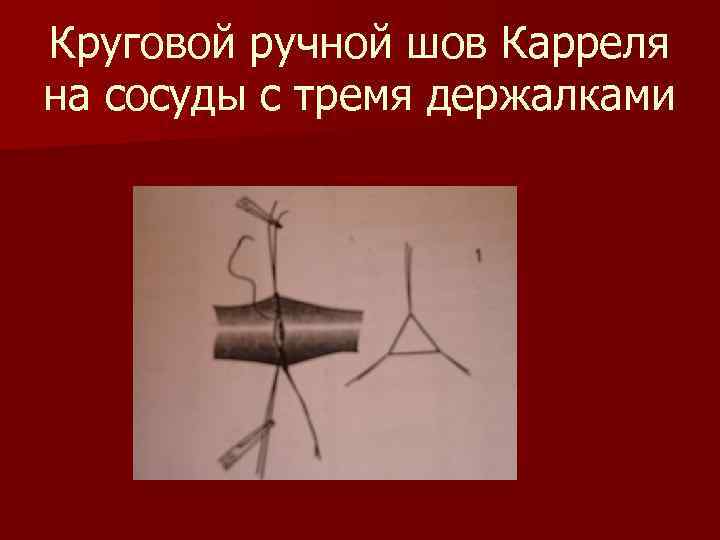 Круговой ручной шов Карреля на сосуды с тремя держалками 