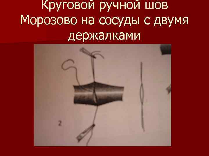 Круговой ручной шов Морозово на сосуды с двумя держалками 