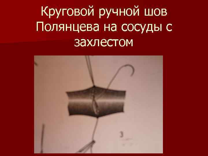 Круговой ручной шов Полянцева на сосуды с захлестом 