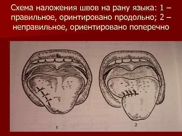 Схема наложения швов на рану языка: 1 – правильное, оринтировано продольно; 2 – неправильное,