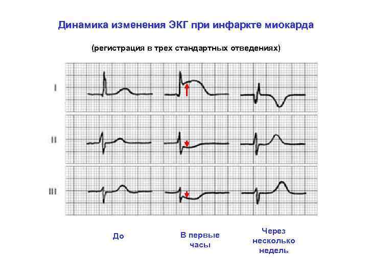 Динамика изменения ЭКГ при инфаркте миокарда (регистрация в трех стандартных отведениях) До В первые