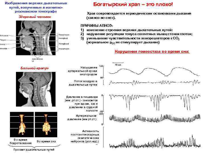 Изображения верхних дыхательных путей, полученные в магнитнорезонансном томографе Здоровый человек Богатырский храп – это