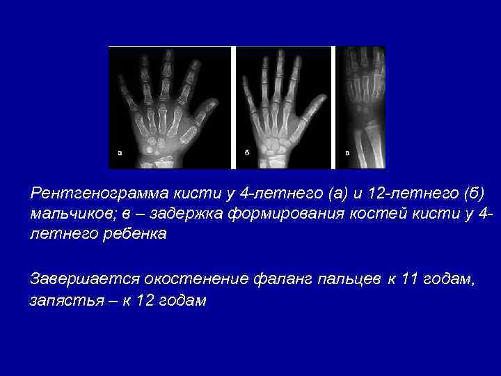 Рентгенограмма кисти у 4 -летнего (а) и 12 -летнего (б) мальчиков; в – задержка