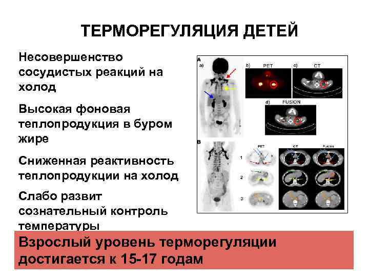 ТЕРМОРЕГУЛЯЦИЯ ДЕТЕЙ Несовершенство сосудистых реакций на холод Высокая фоновая теплопродукция в буром жире Сниженная