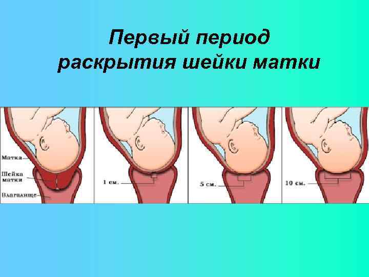 Первый период раскрытия шейки матки 
