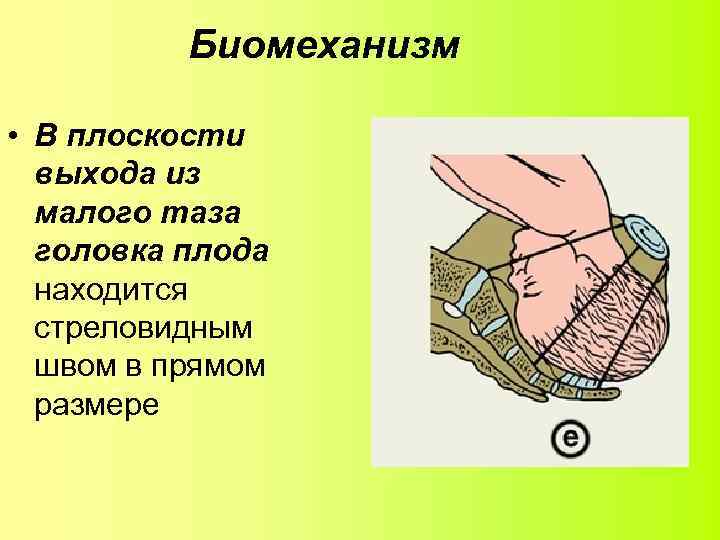Биомеханизм • В плоскости выхода из малого таза головка плода находится стреловидным швом в