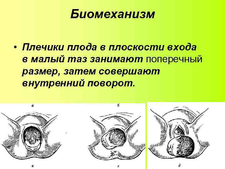 Биомеханизм • Плечики плода в плоскости входа в малый таз занимают поперечный размер, затем